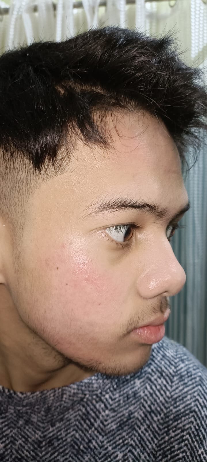 After Face